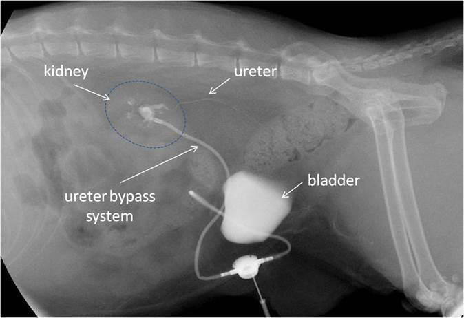 Ureter Bypass System for Treatment of Ureteric Obstruction